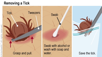 How to remove a tick